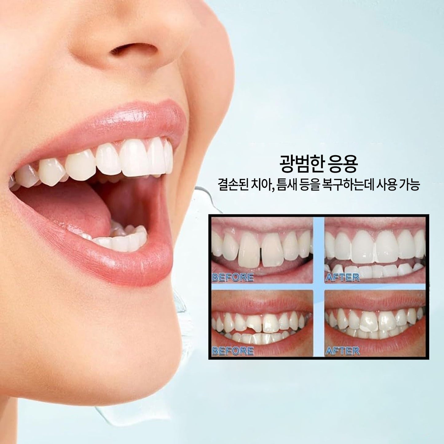 치과용 광경화 복합 수지 키트 충전 재료, 접착제, 시멘트 포함, 자가 수리용 치아 복원 세트