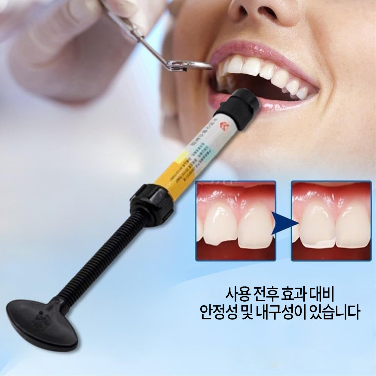 치과용 광경화 복합 수지 키트 충전 재료, 접착제, 시멘트 포함, 자가 수리용 치아 복원 세트