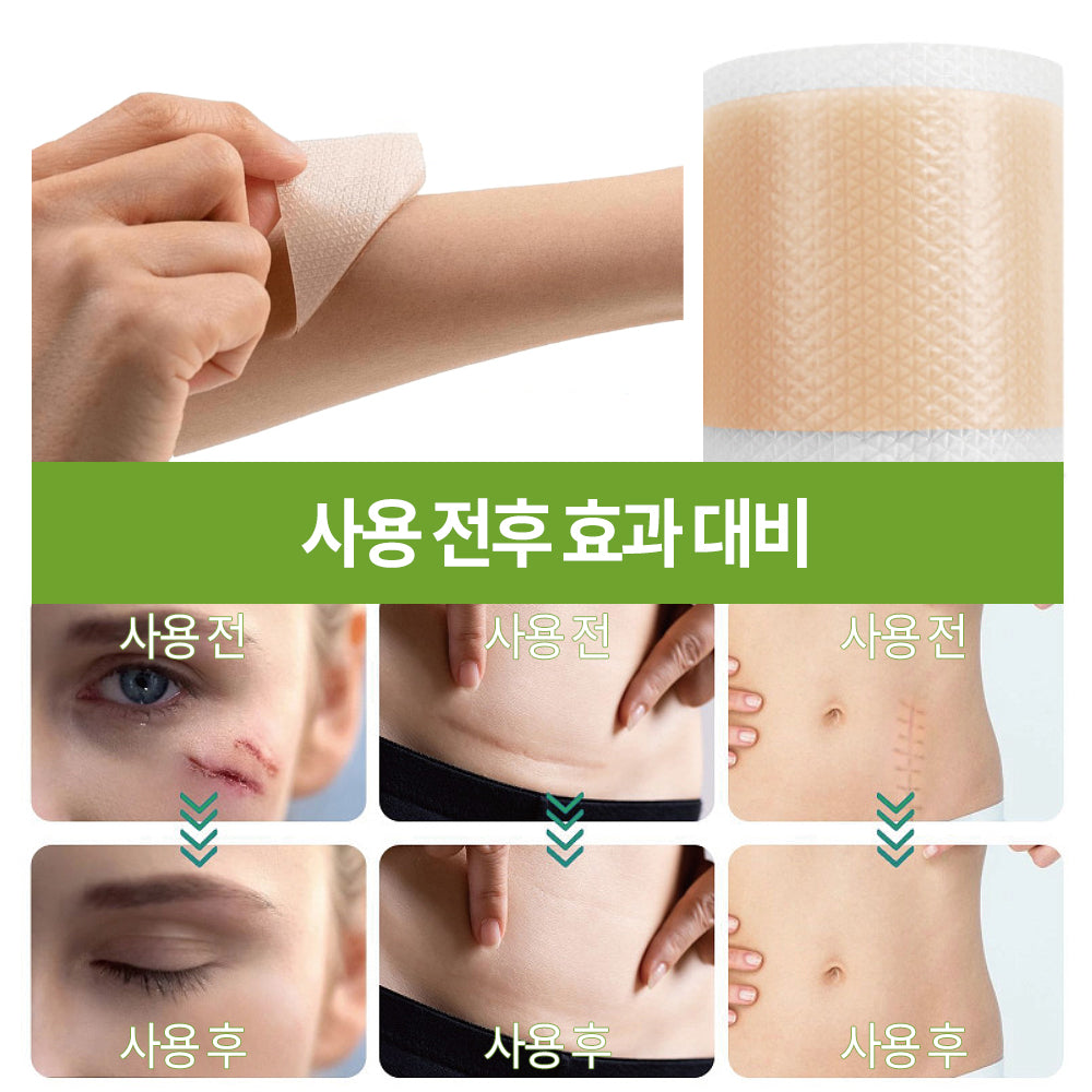 실리콘 흉터 케어 겔 시트 패치, 수술 부위 켈로이드 관리, 얼굴 바디 겸용